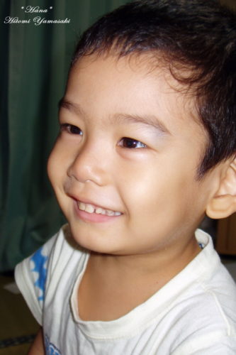 小児白血病の初期症状 顔面蒼白・出血斑・発熱