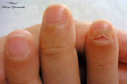 抗がん剤の影響で爪が剥がれかける