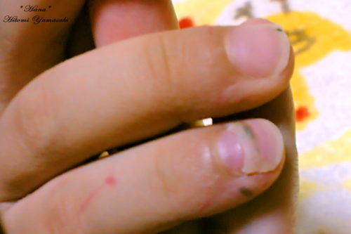 白血病の外来治療中に爪が剥がれる