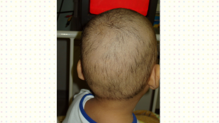 脱毛（抗がん剤の副作用）小児がん・小児白血病
